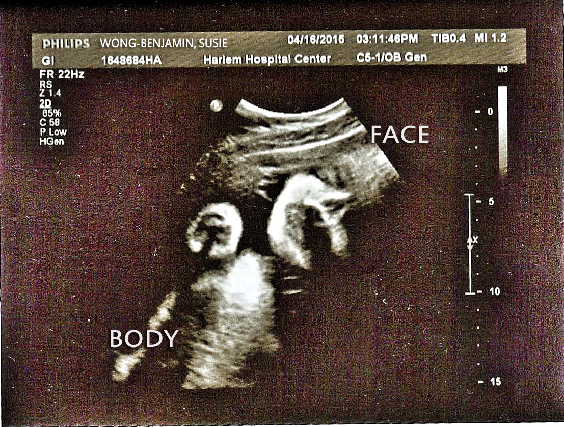Baby Benjamin's serene visage at 34 weeks 1 day.